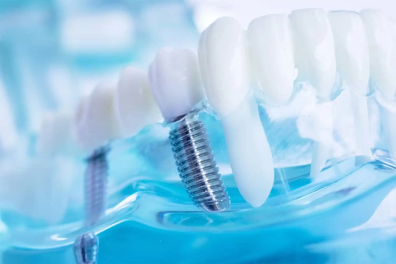 Dental implant screw and crown shown embedded in a transparent model of a jaw and teeth.